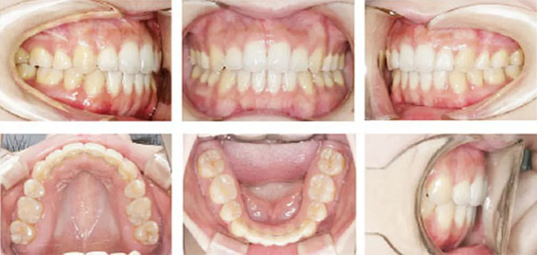 正常咬合 / 不正咬合