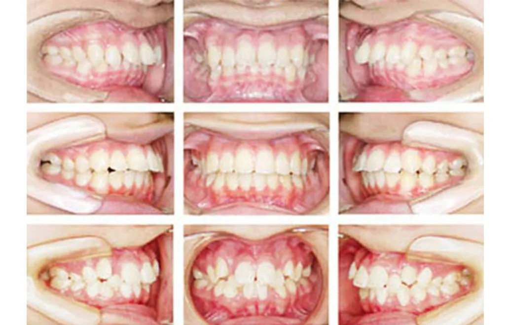 出っ歯(上顎前突)