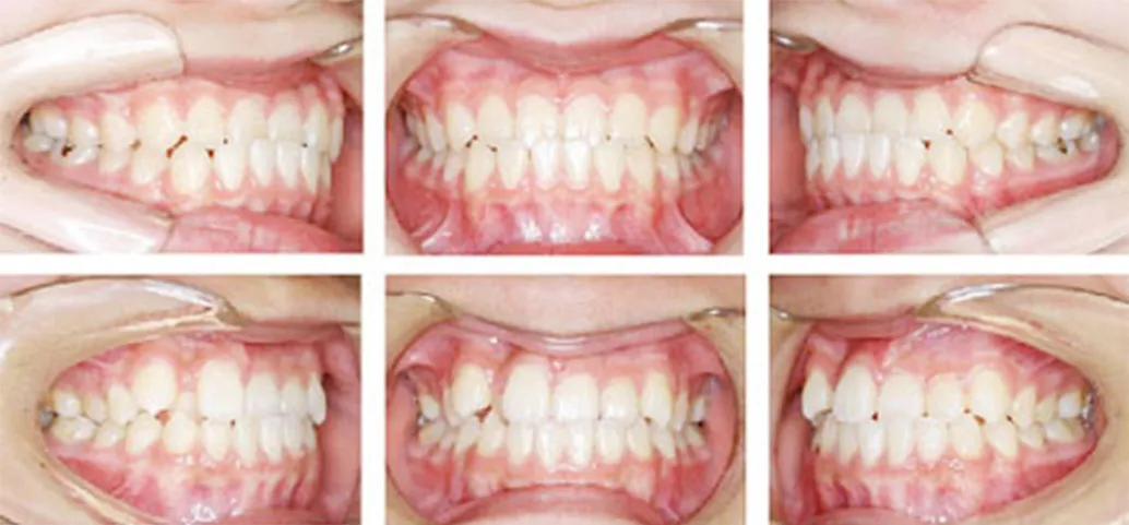 受け口(下顎前突・反対咬合)