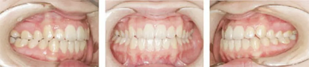 交叉咬合(こうさこうごう)