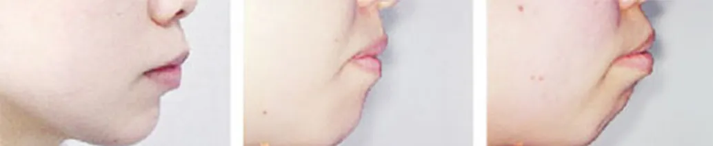 上唇と下唇の突出