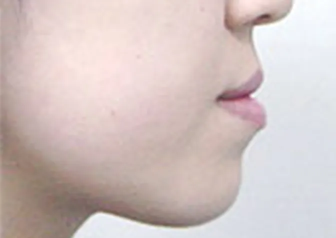 下唇の突出