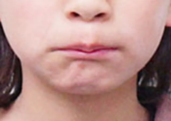 オトガイ筋(下唇の下の筋肉)の緊張