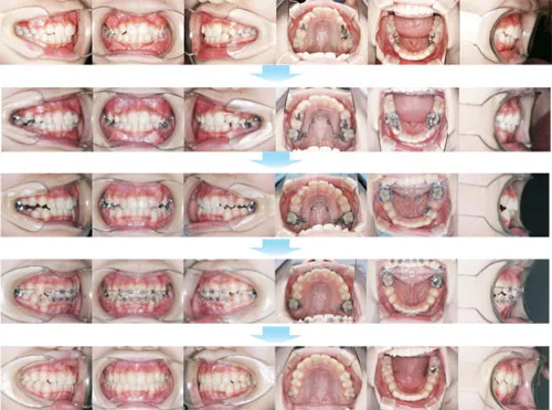 治療例（子供の矯正歯科治療）01