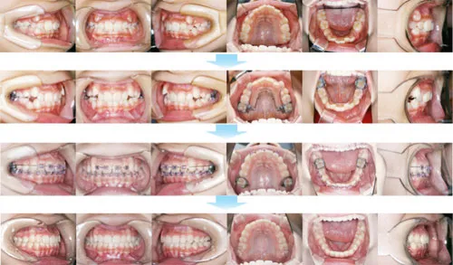 治療例（子供の矯正歯科治療）02