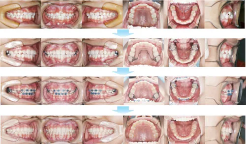治療例（子供の矯正歯科治療）03