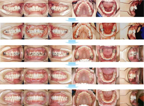 治療例（子供の矯正歯科治療）04