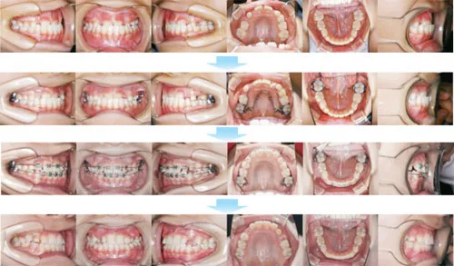 治療例（子供の矯正歯科治療）05