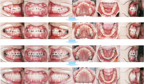 治療例（子供の矯正歯科治療）06