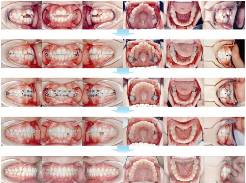 治療例（子供の矯正歯科治療）07