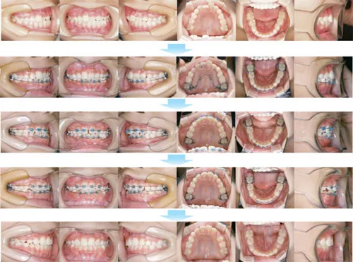 治療例（子供の矯正歯科治療）08