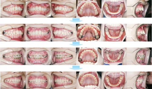 治療例（子供の矯正歯科治療）09