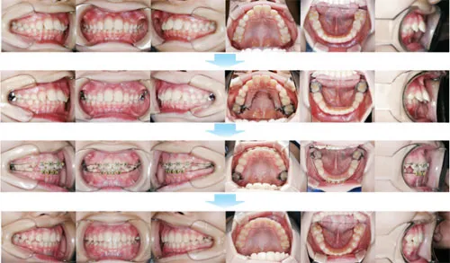 治療例（子供の矯正歯科治療）10