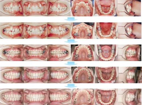 10代前期の矯正歯科治療01