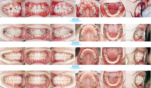 10代前期の矯正歯科治療02