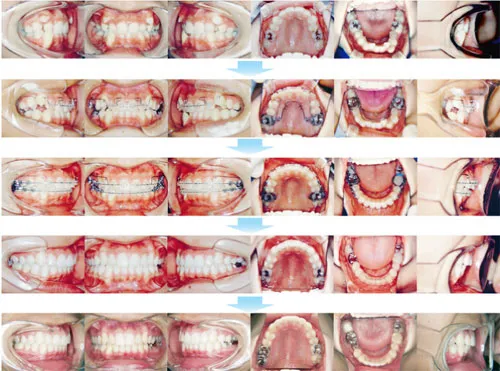 10代前期の矯正歯科治療03