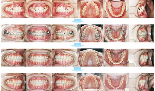 10代前期の矯正歯科治療04