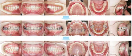 10代前期の矯正歯科治療05
