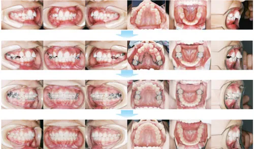 10代前期の矯正歯科治療06