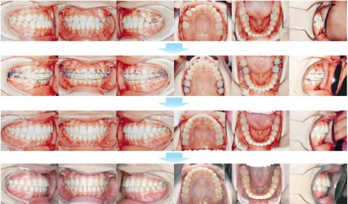 10代前期の矯正歯科治療07