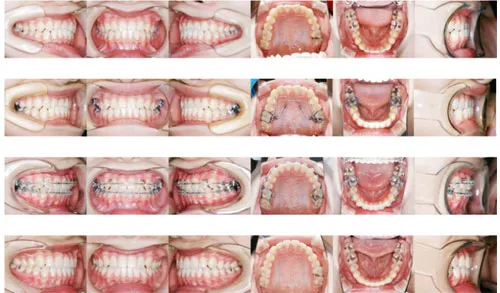 10代前期の矯正歯科治療08
