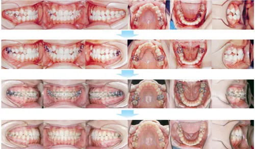 10代前期の矯正歯科治療09