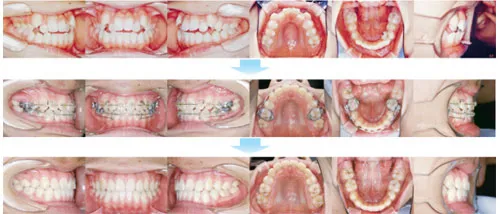 10代前期の矯正歯科治療10