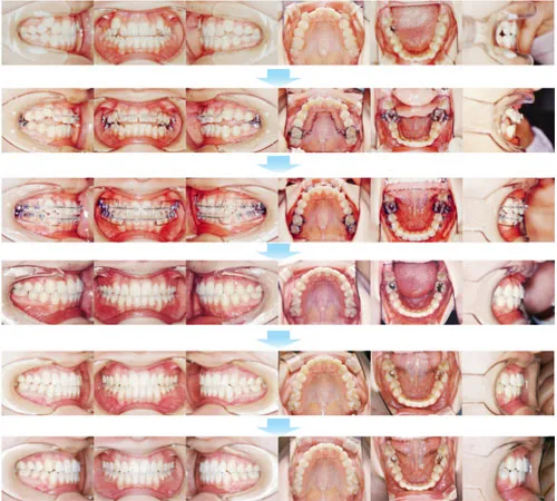 10代前期の矯正歯科治療11