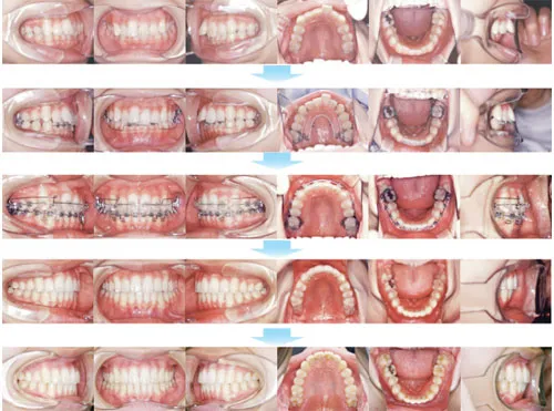 10代前期の矯正歯科治療12