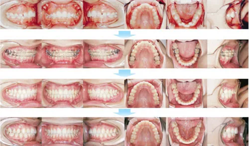 10代前期の矯正歯科治療13