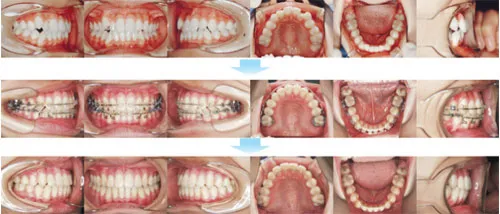 治療例（10代後期の矯正歯科治療）01
