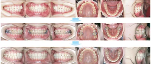 治療例（10代後期の矯正歯科治療）02