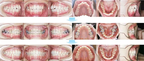 治療例（10代後期の矯正歯科治療）03