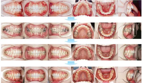 治療例（10代後期の矯正歯科治療）04