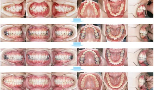 治療例（10代後期の矯正歯科治療）05