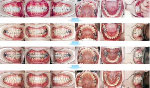 治療例（10代後期の矯正歯科治療）06