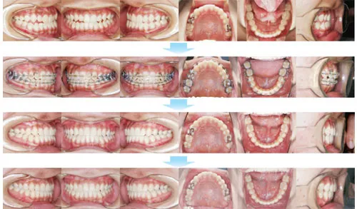治療例（10代後期の矯正歯科治療）07