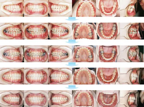 治療例（10代後期の矯正歯科治療）08