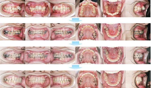 治療例（10代後期の矯正歯科治療）09