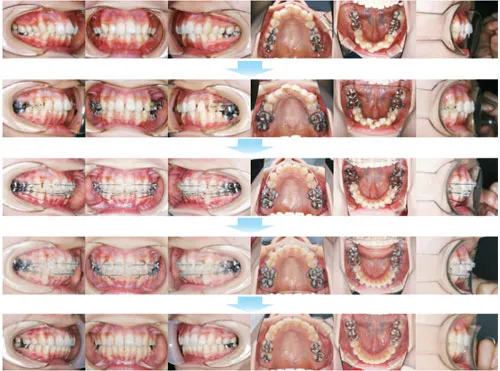 治療例（大人の矯正歯科治療）01