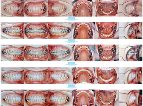 治療例（大人の矯正歯科治療）02