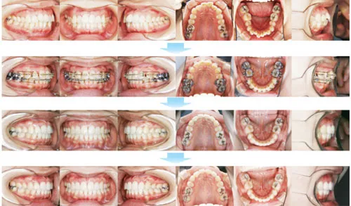 治療例（大人の矯正歯科治療）03