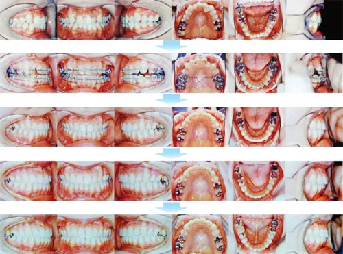 治療例（大人の矯正歯科治療）04