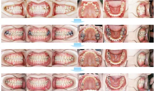 治療例（大人の矯正歯科治療）05