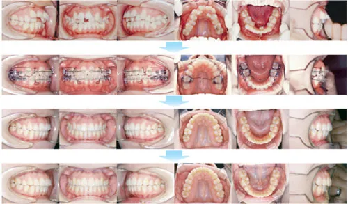 治療例（大人の矯正歯科治療）06