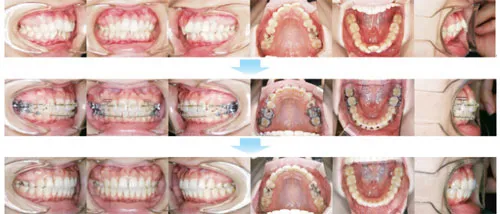 治療例（大人の矯正歯科治療）07