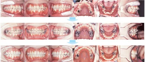 治療例（大人の矯正歯科治療）08
