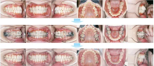 治療例（大人の矯正歯科治療）09