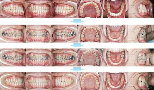 治療例（大人の矯正歯科治療）10