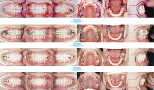 治療例（大人の矯正歯科治療）11